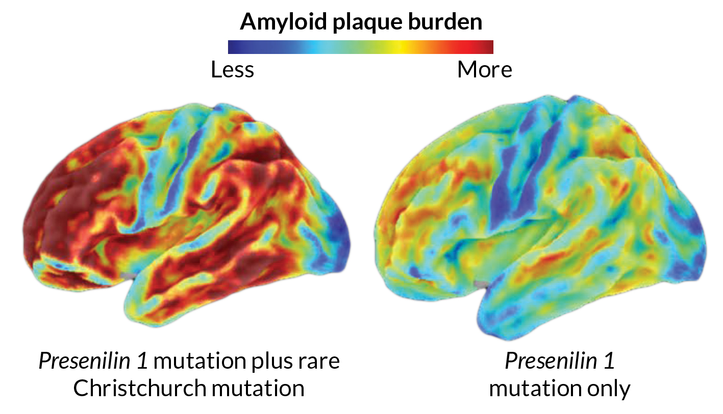 brains with amyloid plaques